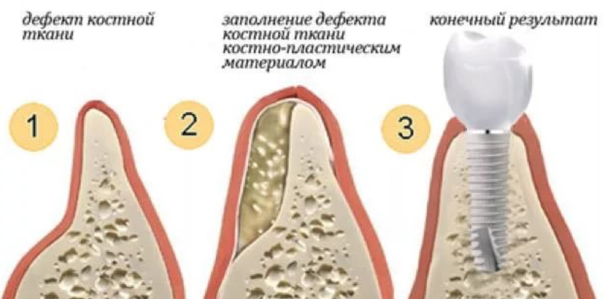 Восстановление костной ткани зубов. Костная ткань для имплантации. Пластика кости при имплантации костной ткани. Костная пластика (остеопластика).