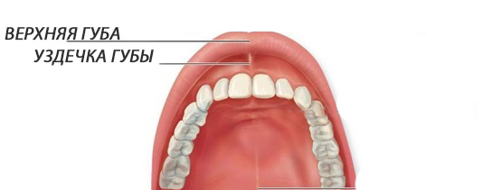 Подрезание уздечки верхней губы